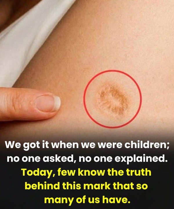 The Small Round Scar Many People Share—and the Truth Behind It