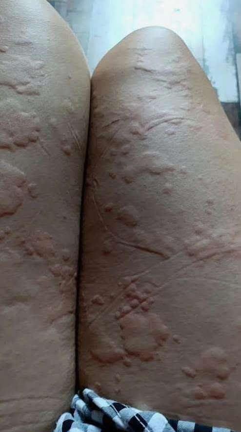 Multiple Red Patches on Skin Plus Breathing Difficulty Could Be a Sign of…See More