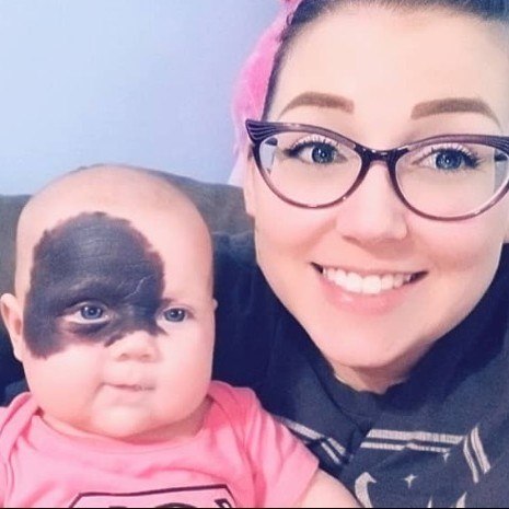 Every child is precious in God\’s sight. Natalie was born with this birthmark. Her mom said ”As I cuddled our gorgeous baby girl, feeling enamoured by her, I worried that people might just see her for her birthmark, and not the beautiful person I knew she would grow to be.” Now, try not to cry when you see this precious baby 7 years later — photos in the comments 😲