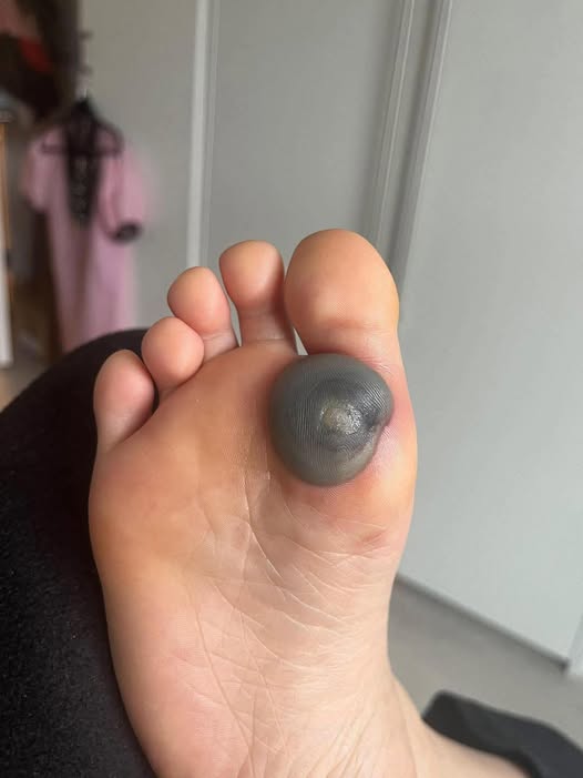 My daughter woke up with this huge spot on her foot I don’t know what it could be