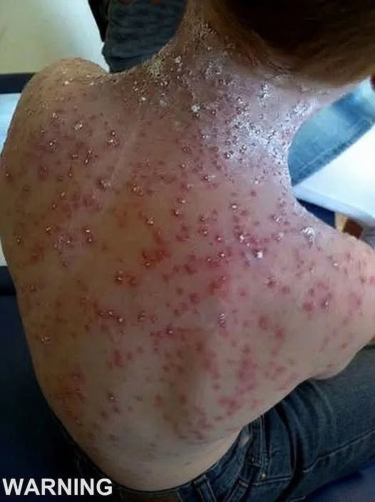 This is the silent disease that is triggered when you come into contact with … See more