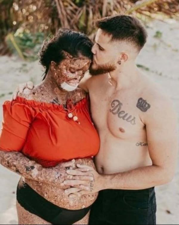 She was bullied by people who didn’t understand her condition – they called her rude names & said such as monster” & ”zombie”. But her husband has the perfect response to haters .