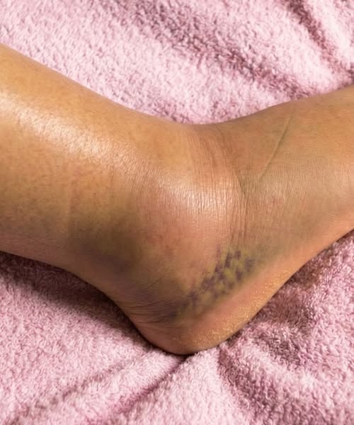 If you notice your legs are swollen, that’s a sign of ca…