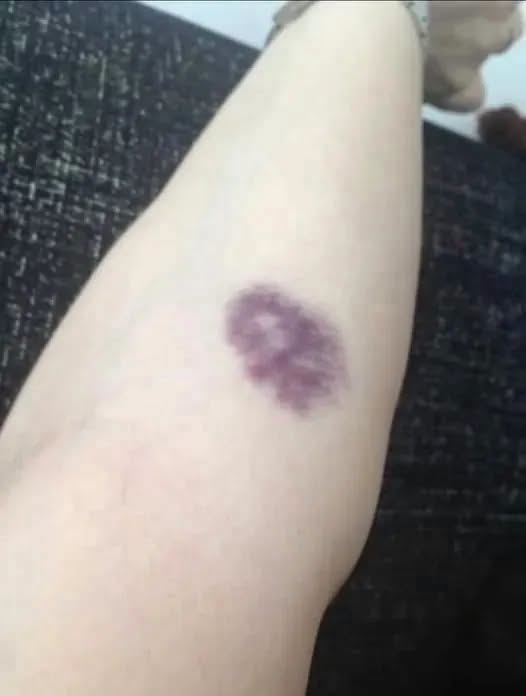BE CAREFUL, if you get these bruises on your body, it means you have Ca…see more