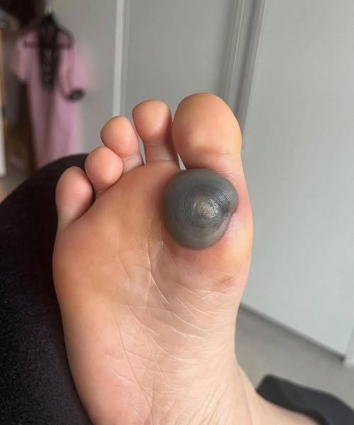 My daughter woke up with this huge spot on her foot I don’t know what it could be. She’s been in pain and can’t move her foot what is this..