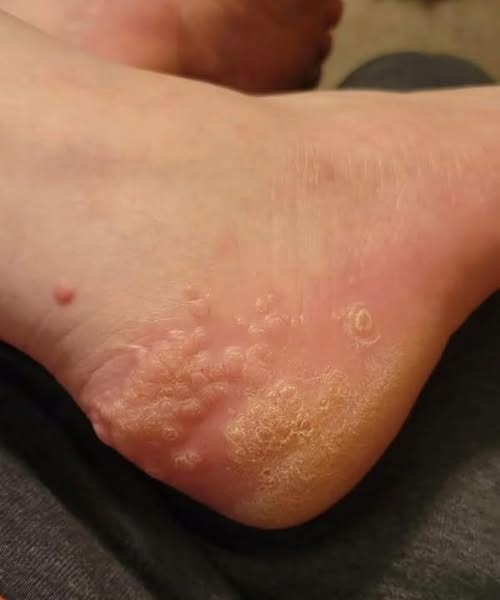 My 9-year-old son has been wearing a kid’s shoes that lives down the street from our house and now he’s dealing with yellow bumps… What is it?