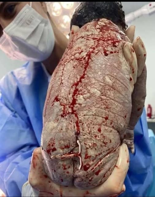Baby born with an DIU peg… See more